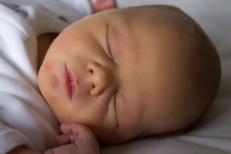 تشخیص ، درمان و علت زردی نوزاد چیست؟